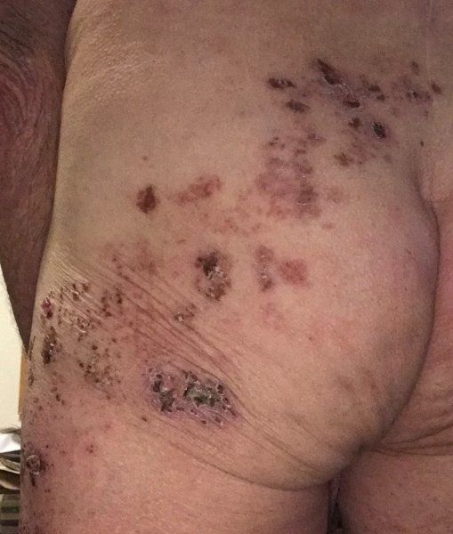 Shingles on buttocks.jpg
