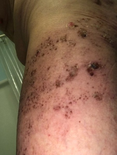 Shingles on side of thigh.jpg