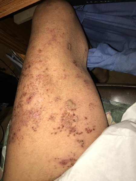 Shingles on thigh.jpg